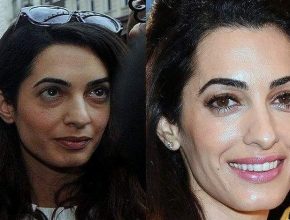 Amal Clooney before and after plastic surgery