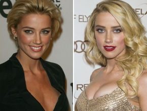 Amber Heard before and after plastic surgery