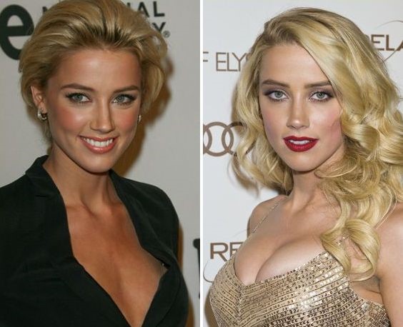Amber Heard before and after plastic surgery