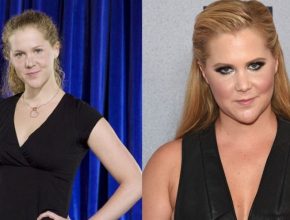 Amy Schumer before and after plastic surgery