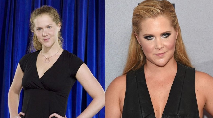 Amy Schumer before and after plastic surgery