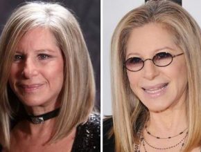 Barbra Streisand before and after plastic surgery (25)