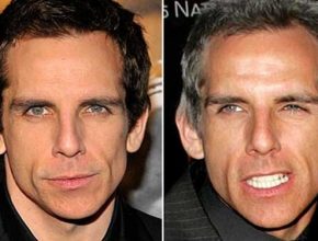 Ben Stiller before and after plastic surgery (9)