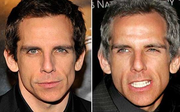 Ben Stiller before and after plastic surgery