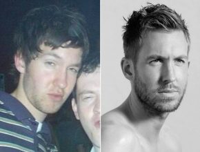 Calvin Harris before and after plastic surgery (35)