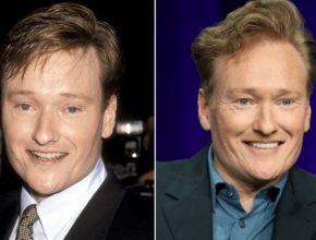 Conan O'Brien before and after plastic surgery (1)