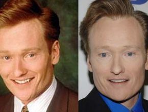 Conan O'Brien before and after plastic surgery (2)