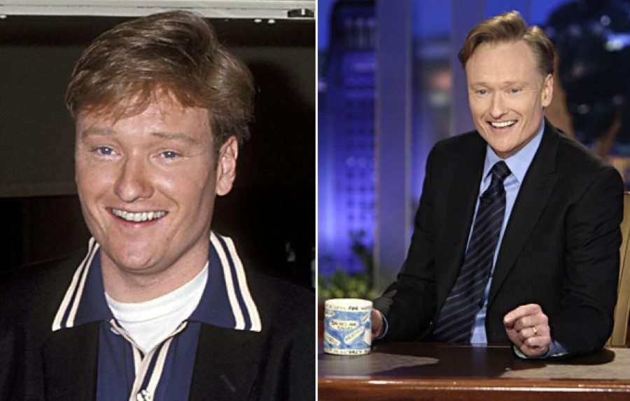 Conan O'Brien before and after plastic surgery