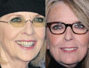 Diane Keaton before an after plastic surgery