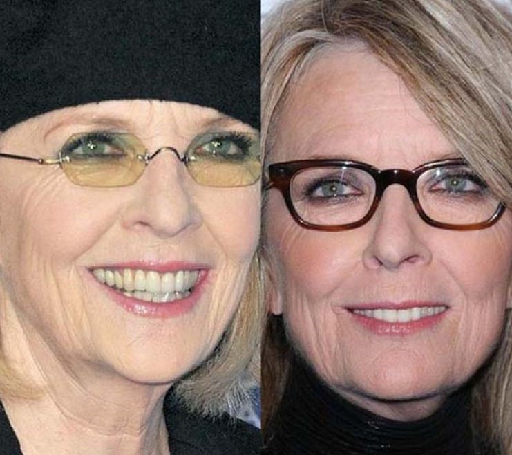 Diane Keaton before an after plastic surgery