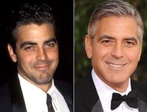 George Clooney before and after plastic surgery