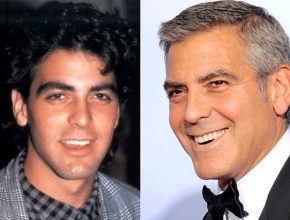 George Clooney before and after plastic surgery (21)