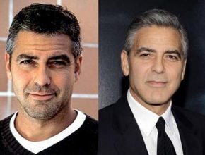 George Clooney before and after plastic surgery (22)