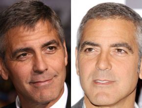 George Clooney before and after plastic surgery (4)