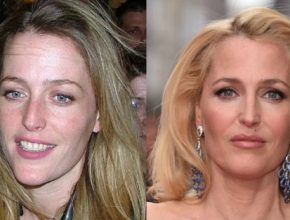 Gillian Anderson before amd after plastic surgery
