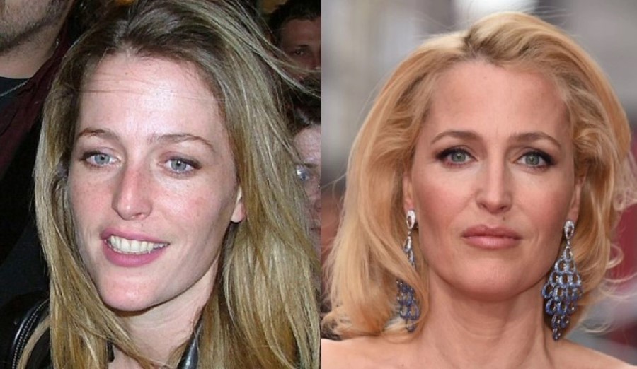 Gillian Anderson before amd after plastic surgery