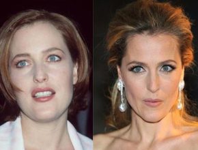 Gillian Anderson before and after plastic surgery (12)