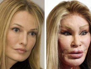 Jocelyn Wildenstein before and after plastic surgery