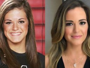 Jojo Fletcher before and after plastic surgery