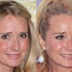 Kim Richards before and after plastic surgery (21)