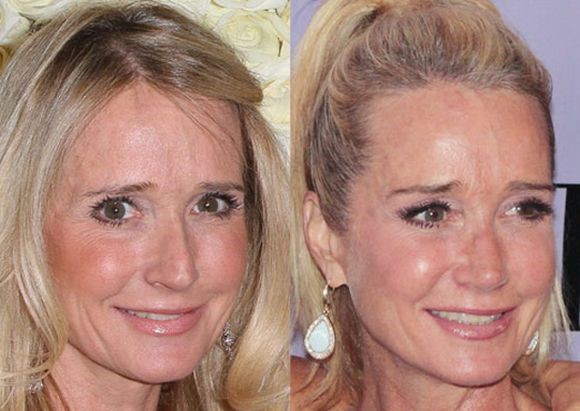 Kim-Richards-before