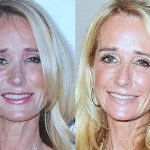 Kim Richards before and after plastic surgery (39)
