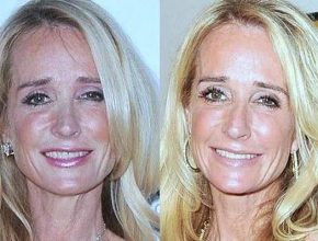 Kim Richards before and after plastic surgery (39)