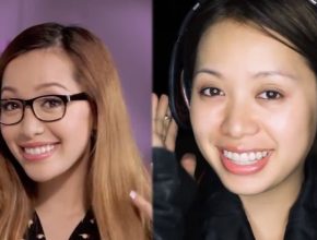 Michelle Phan before and after plastic surgery