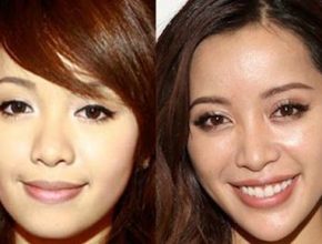 Michelle Phan before and after plastic surgery (9)