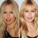 Rachel Zoe before and after plastic surgery (1)