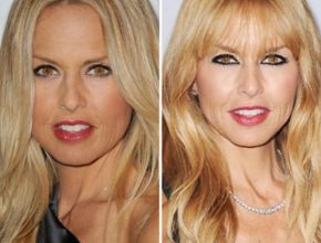Rachel Zoe before and after plastic surgery (1)