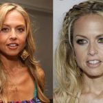 Rachel Zoe before and after plastic surgery (41)