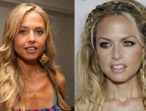 Rachel Zoe before and after plastic surgery (41)