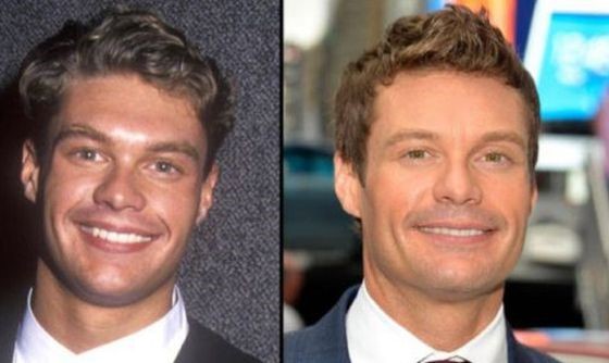 Ryan Seacrest before and after plastic surgery