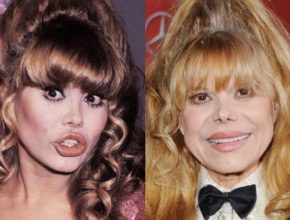 Charo before and after plastic surgery