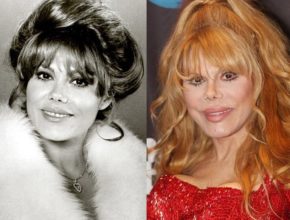 Charo before and after plastic surgery