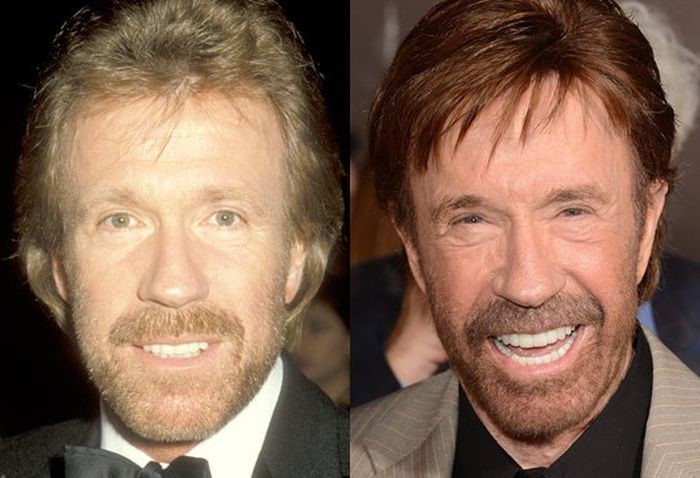 Chuck Norris before and after plastic surgery