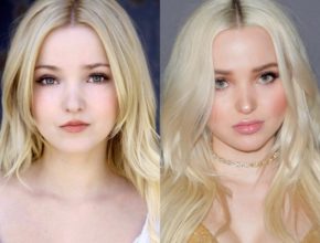 Dove Cameron before and after plastic surgery