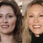 Faye Dunaway before and after plastic surgery (38)