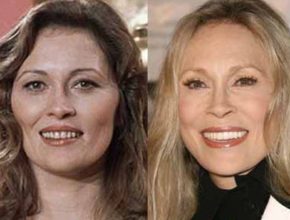 Faye Dunaway before and after plastic surgery (38)