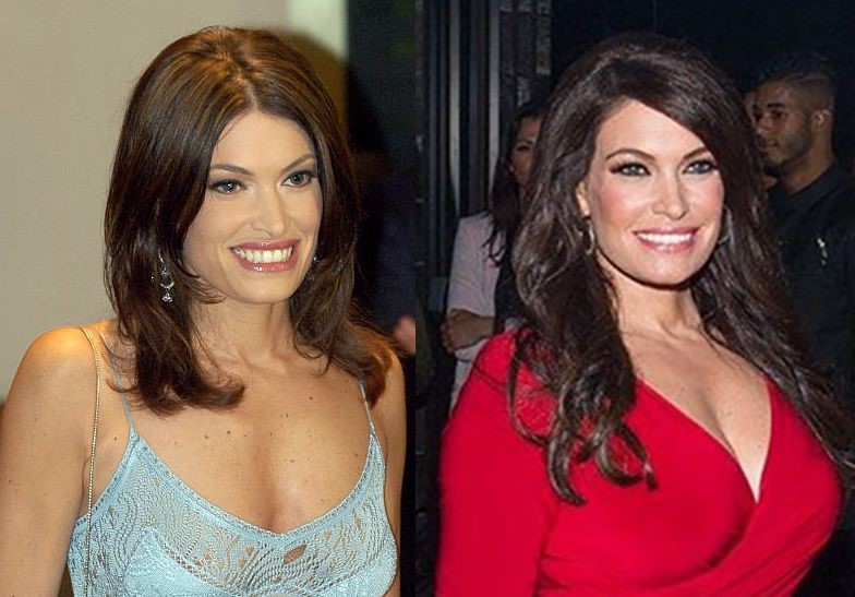Kimberly Guilfoyle before and after plastic surgery.