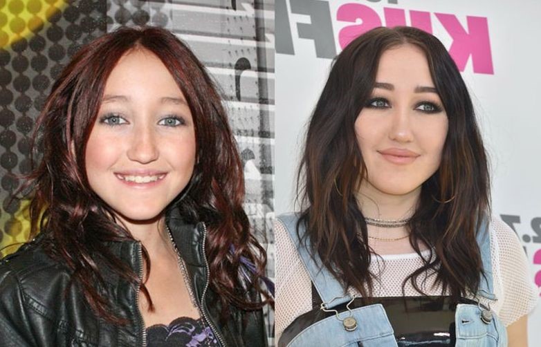 Noah Cyrus before and after plastic surgery.