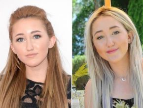 Noah Cyrus before and after plastic surgery (6)