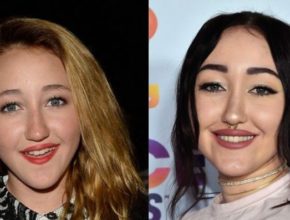 Noah Cyrus before and after plastic surgery (6)